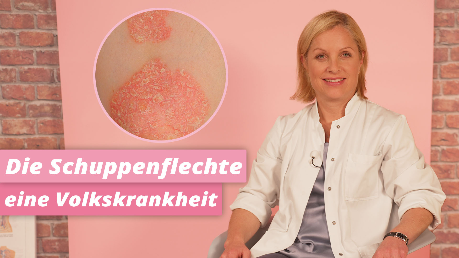 Vorschaubild zum Kurs: Psoriasis (Schuppenflechte) - eine Volkskrankheit